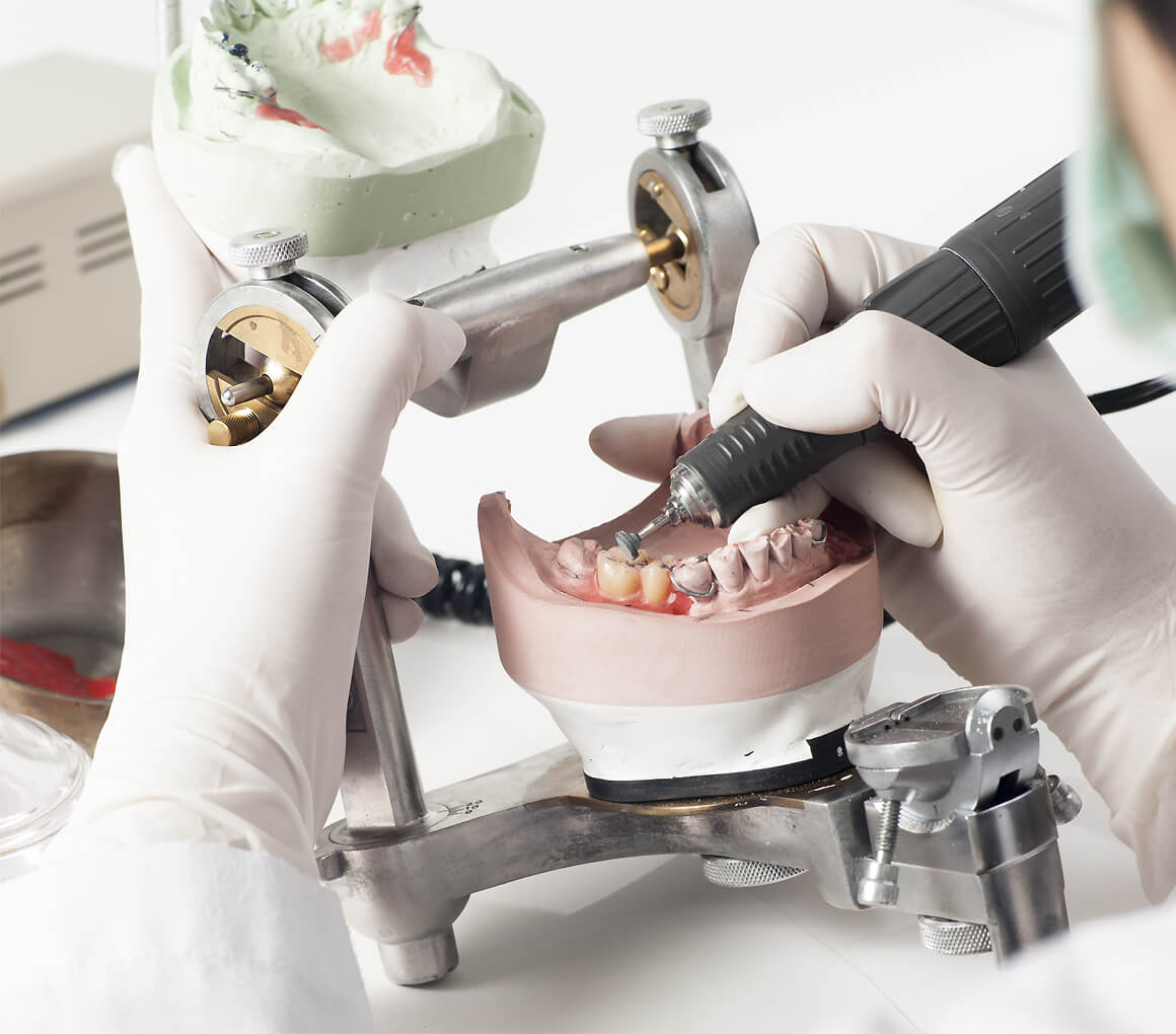 Protesi dentali fisse e mobili a Bologna
